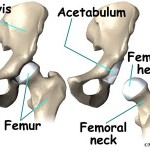 depuy defective hip replacement new jersey and philadelphia attorneys