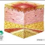 Bed Sores Stages - Stage I