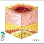 Bed Sores Stages - Stage II