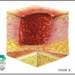 Bed Sores Stages - Stage III