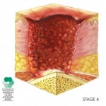 Bed Sores Stages - Stage IV